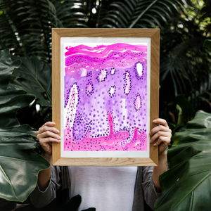 Psoriasis Skin Histopathology Art Print