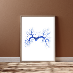 Pulmonary Embolism CT Angiography Watercolor Art Print