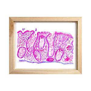 Crohn´s Disease Histopathology Art Print