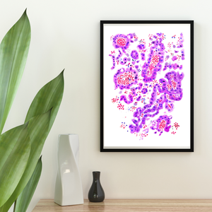 Lung Papillary Adenocarcinoma Pathology Art Print