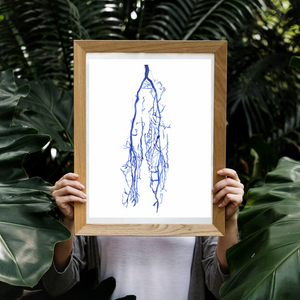 Lover Limb Varicose Vein Venography Art