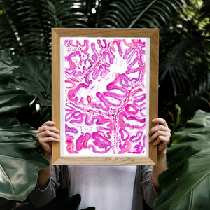 Endometrial Cancer Art Print