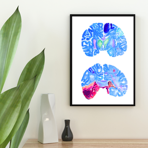 Stroke Art, Pathology Wall Decor, Neurology Print