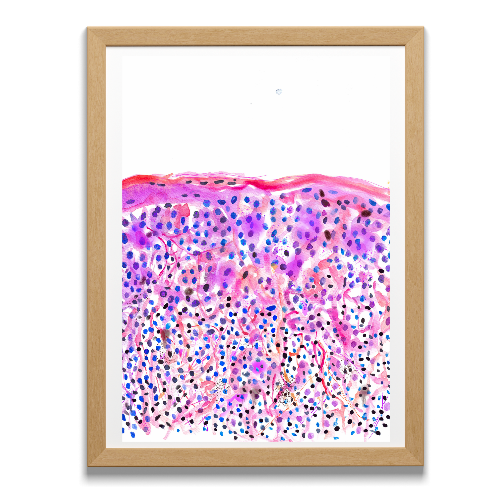 skin cancer watercolor art print