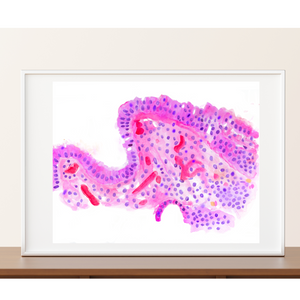 Barrett´s Esophagus Histopathology Art Print