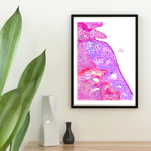 Oropharyngeal Squamous Cell Carcinoma Pathology Art