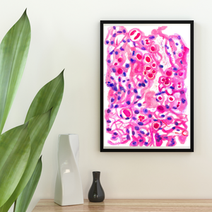 Meningioma Neuropathology Watercolor Art Print