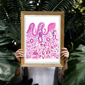 Stomach Signet Ring Carcinoma Histopathology Art