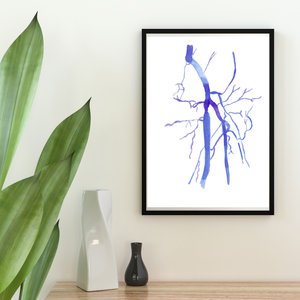 Femoral Artery Occlusion DSA Watercolor Anatomy Art Print