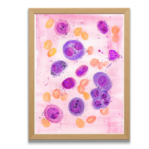 Multiple Myeloma Histopathology Art