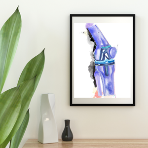 Knee Replacement Orthopedic Surgery Art Print