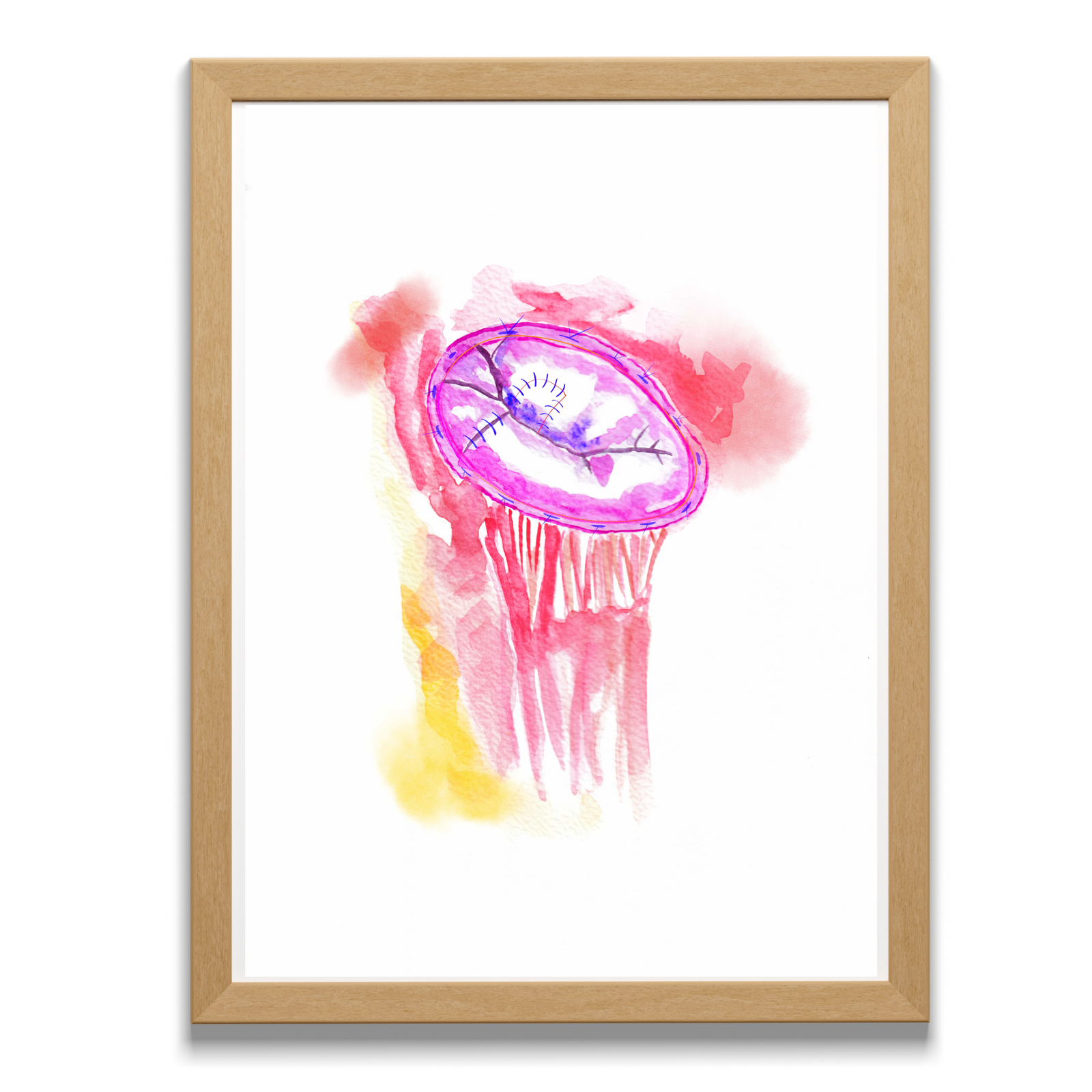 mitral valve replacement surgery art