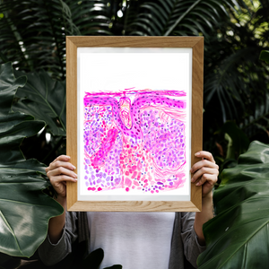 Basal Cell Carcinoma Skin Histopathology Artwork