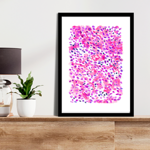 Lung Small Cell Carcinoma Pathology Art Print