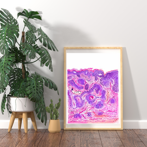Vulvar Carcinoma Gynecological Pathology Art Print