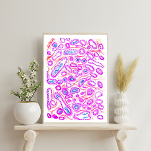 Prostate Adenocarcinoma Uropathology Art Print