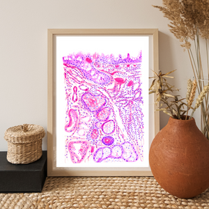 Chronic Conjunctivitis Histopathology Art Print