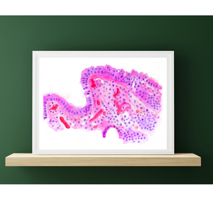 Barrett´s Esophagus Histopathology Art Print