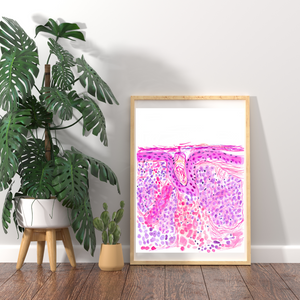 Basal Cell Carcinoma Skin Histopathology Artwork