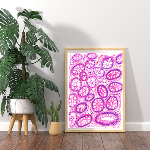 Colon Polyp - Tubular Adenoma Histopathology Art