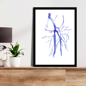 Femoral Artery Occlusion DSA Watercolor Anatomy Art Print