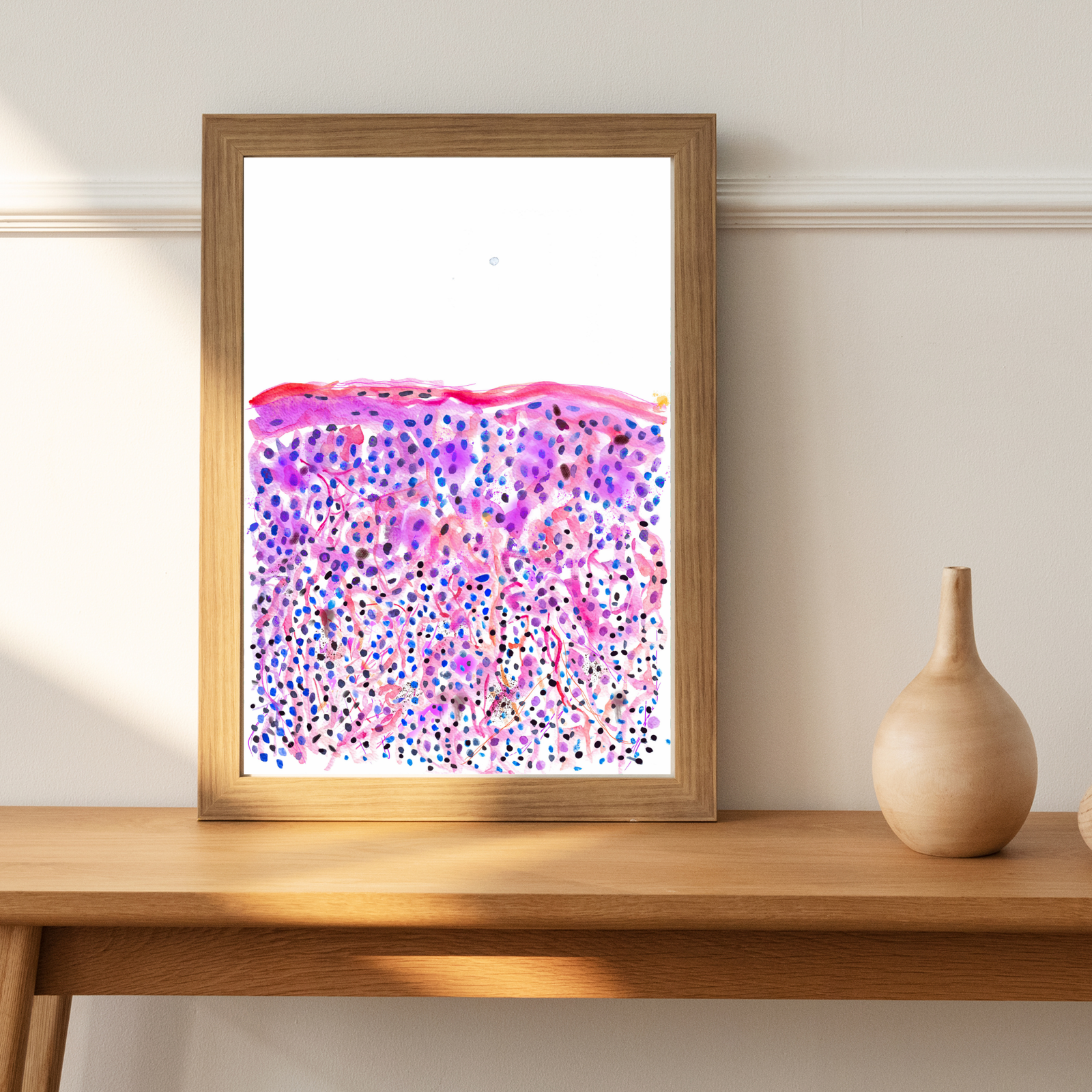 skin cancer watercolor art print