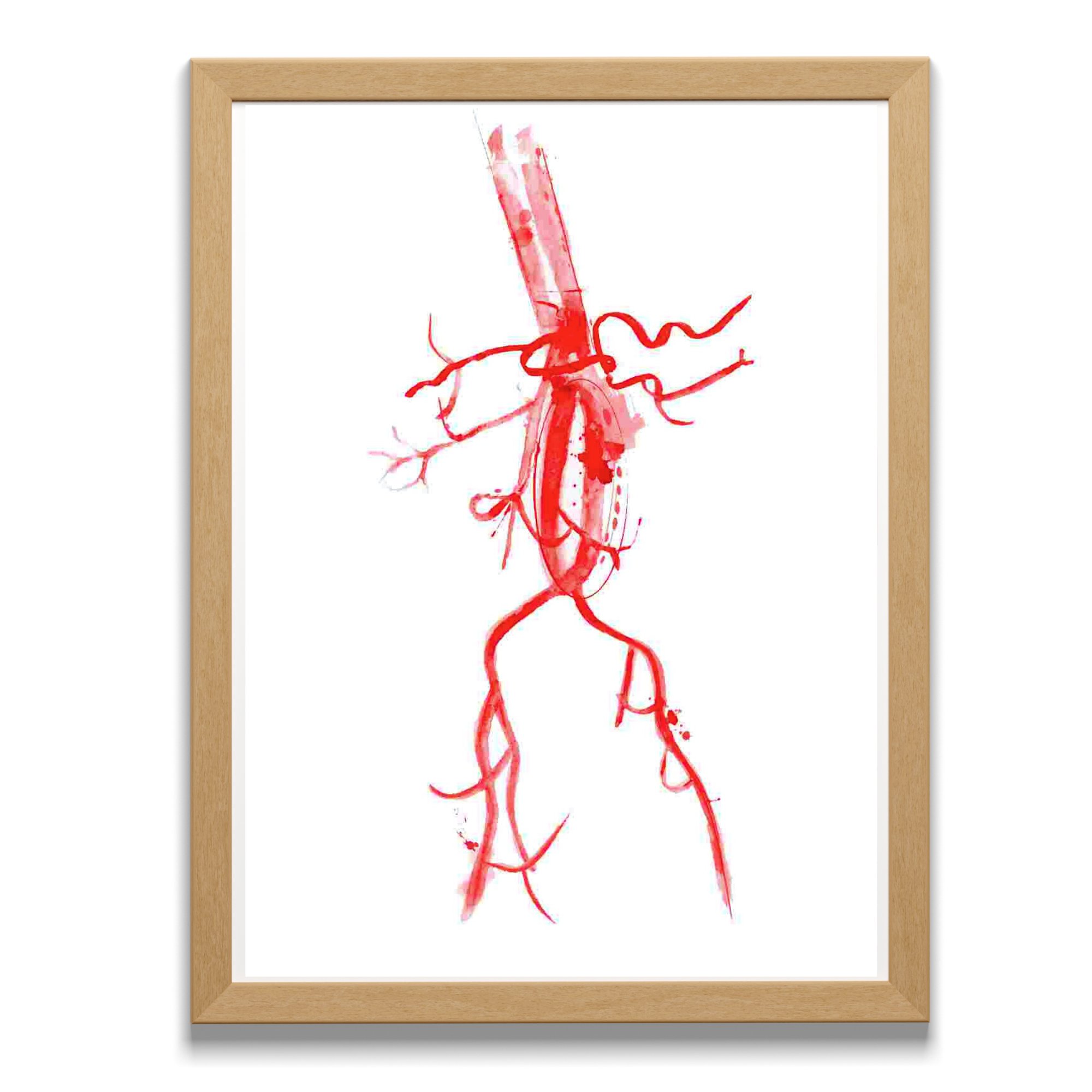 Abdominal Aorta Aneurysm