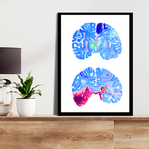 Stroke Art, Pathology Wall Decor, Neurology Print