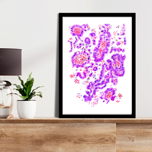 Lung Papillary Adenocarcinoma Pathology Art Print