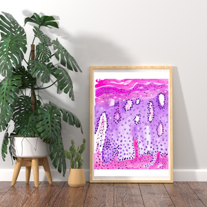 Psoriasis Skin Histopathology Art Print