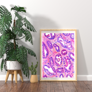 Ovarian Cancer Histopathology Art