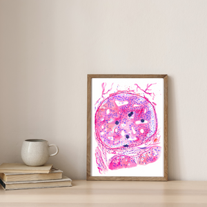 Breast Cancer Histopathology Art - DCIS