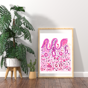 Stomach Signet Ring Carcinoma Histopathology Art