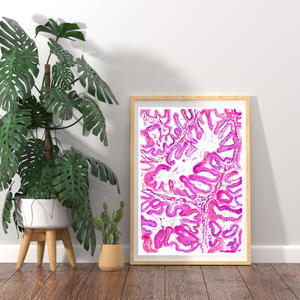 Endometrial Cancer Art Print
