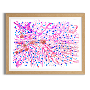 hematochromatosis art print
