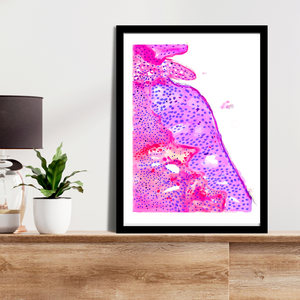 Oropharyngeal Squamous Cell Carcinoma Pathology Art