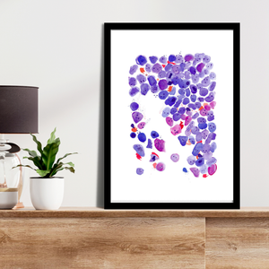 Acute Myeloid Leukemia Art Print