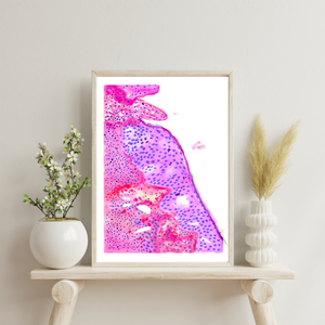 Oropharyngeal Squamous Cell Carcinoma Pathology Art