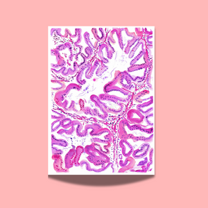 Endometrial Cancer Art Print
