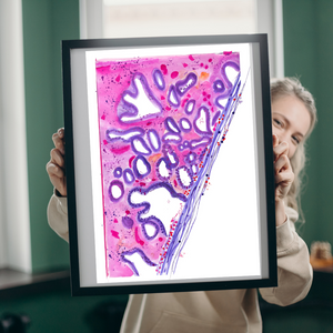 Cervical Cancer Histopathology, Uterine Histology Art, OBGYN Art, Gynecology Art, Gynecologist Gift, Pathology Art, Pathologist Gift