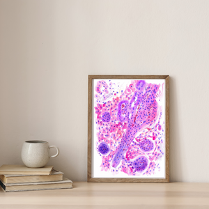 Glioblastoma Neuropathology Watercolor Art Print