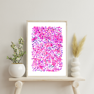 Lung Small Cell Carcinoma Pathology Art Print