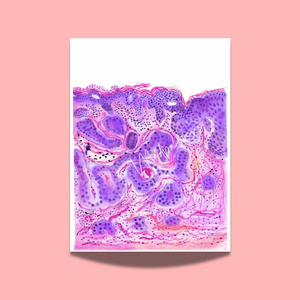 Vulvar Carcinoma Gynecological Pathology Art Print