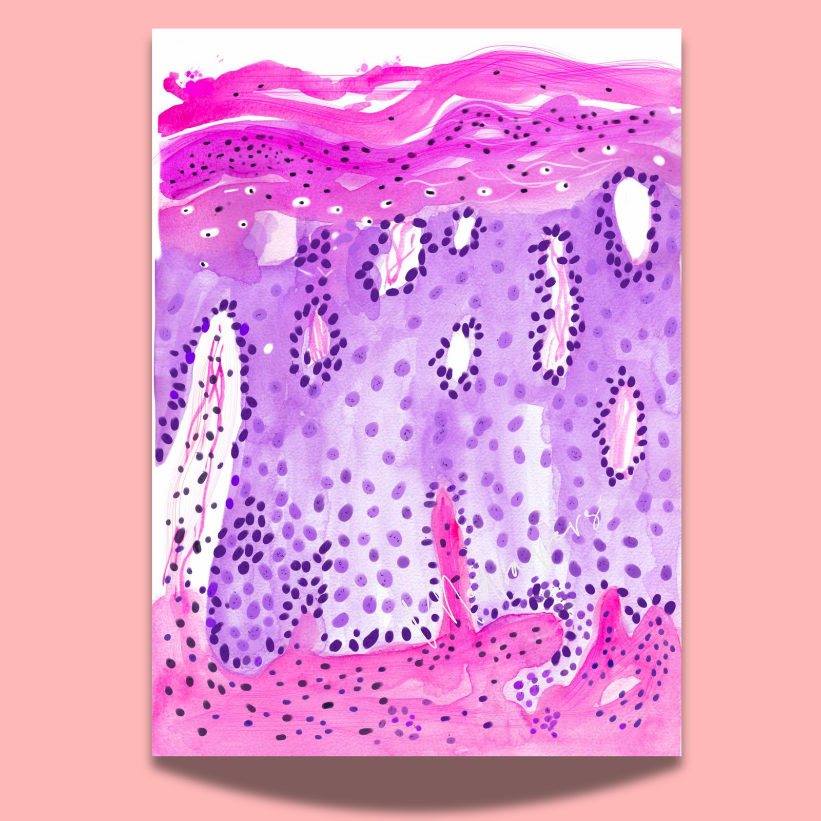 Psoriasis Skin Histopathology Art Print
