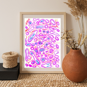 Prostate Adenocarcinoma Uropathology Art Print