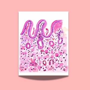 Stomach Signet Ring Carcinoma Histopathology Art