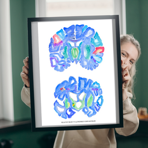Brain Anatomy Alzheimer Disease, Neurology Art Print