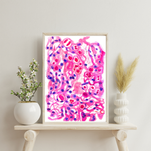 Meningioma Neuropathology Watercolor Art Print