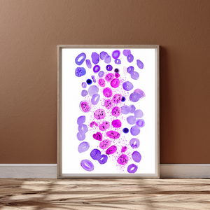 Systemic Mastocytosis Watercolor Art Print