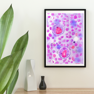 hodgkin lymphoma hematopathology art
